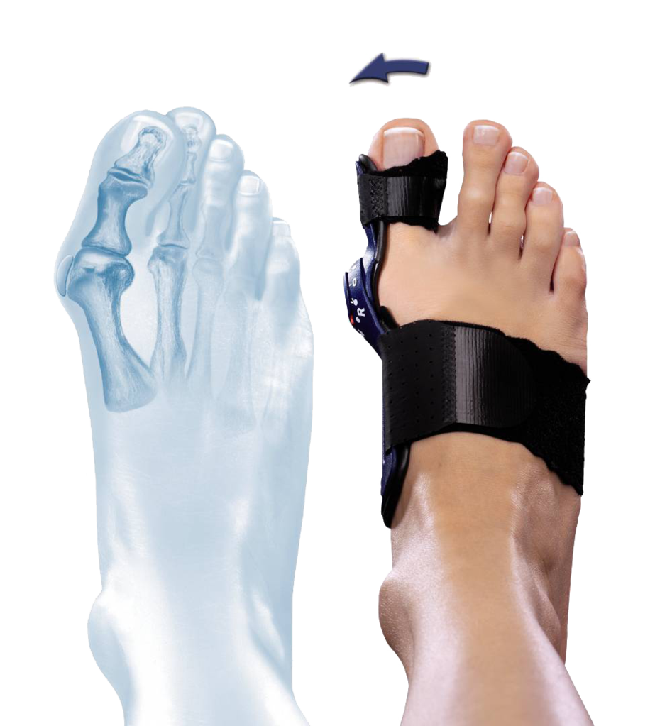 Hallux Stabilizing Orthosis Valguloc II Bauerfeind